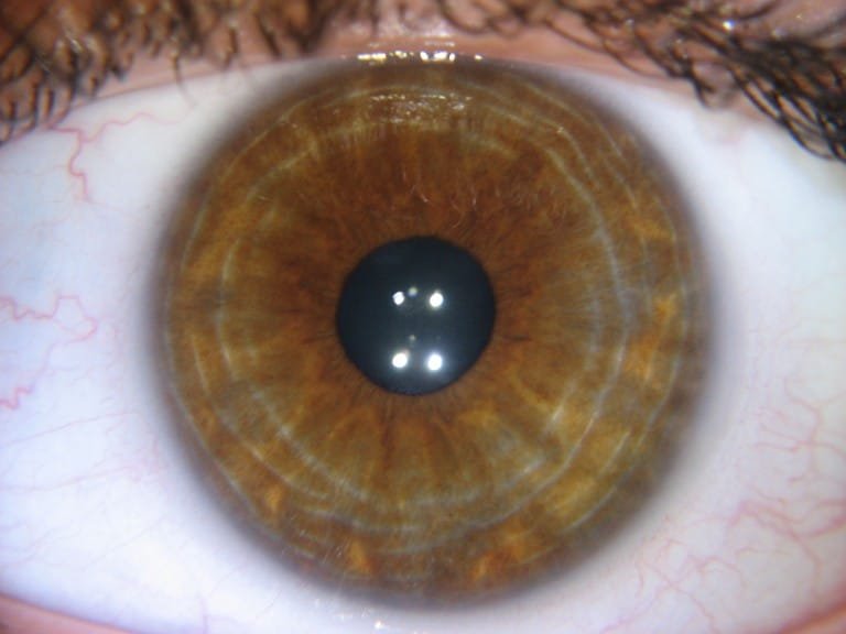 iridology stress ringswhat,why,and the mean iriscope iridology
