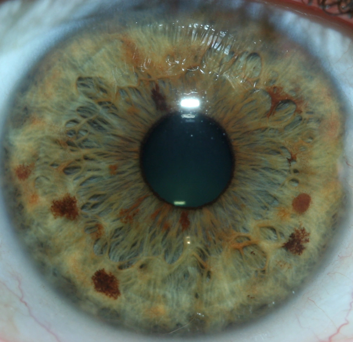 iridology pictures 4