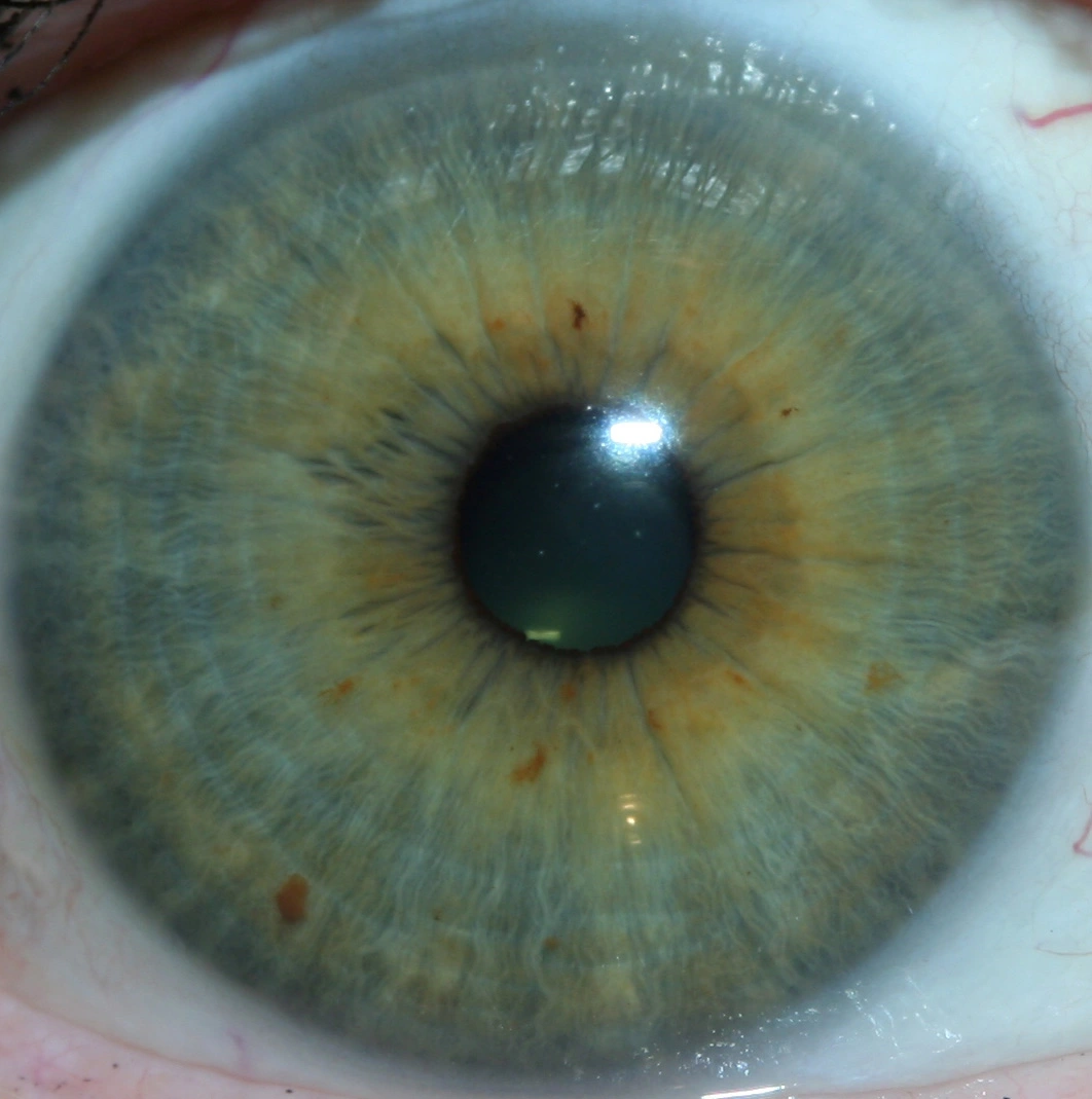 iridology pictures 5
