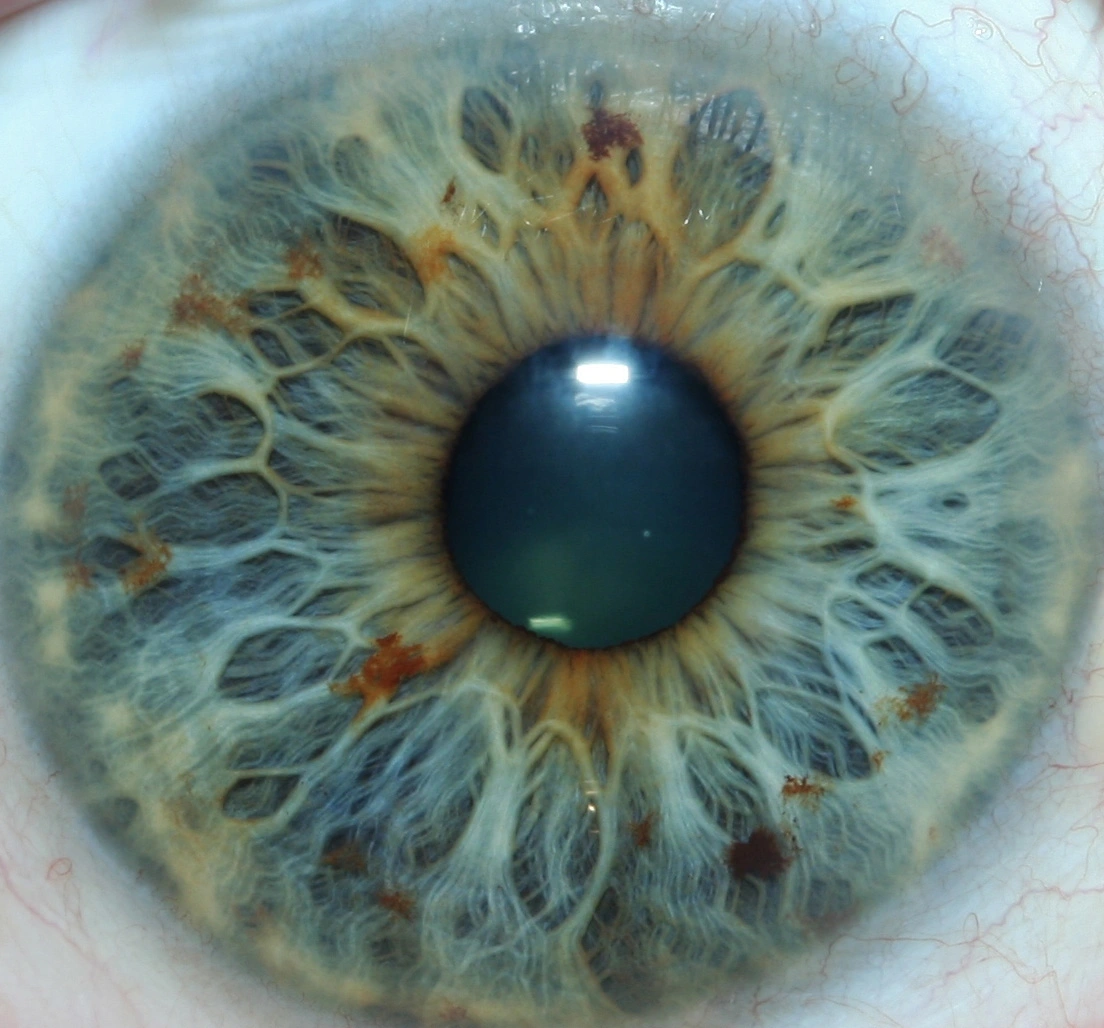 iridology pictures 6