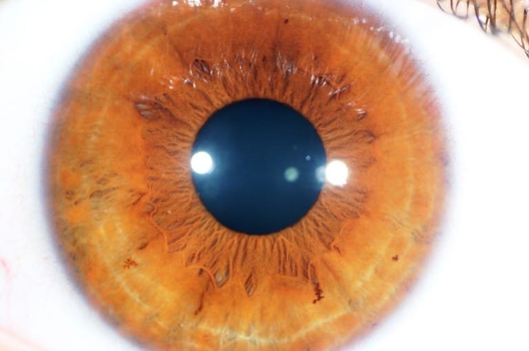 faded yellow around pupil faded yellow around pupil